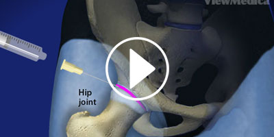 HIP-JOINT-INJECTION